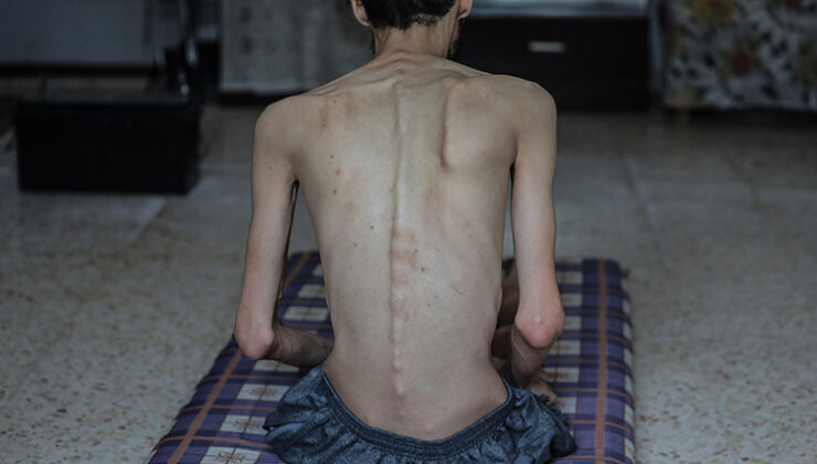 İşgalcilerin kıtlığı dayattığı Gazze’de son 24 saatte 10 kişi daha açlıktan şehit oldu