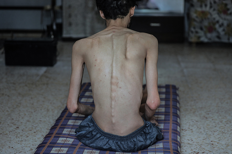 İşgalcilerin Kıtlığı Dayattığı Gazze'de Son 24 Saatte 10 Kişi Daha Açlıktan Şehit Oldu (1)